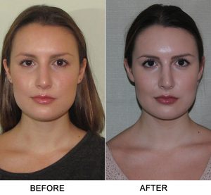 septoplasty-before-and-after1