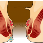 Hemorrhoid disease and surgery cost details