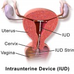 IUD test price for birth control