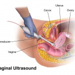 Vaginal ultrasound overview of cost