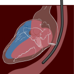 Nuclear stress test on heart cost analysis