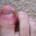 Ingrown Toenail