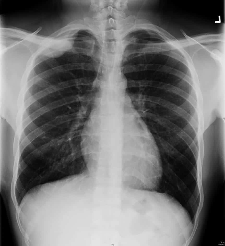 How Much Does A Chest X Ray Cost In 2022 
