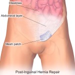 Hernia Surgery