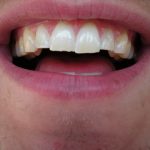 Fix a Chipped Tooth