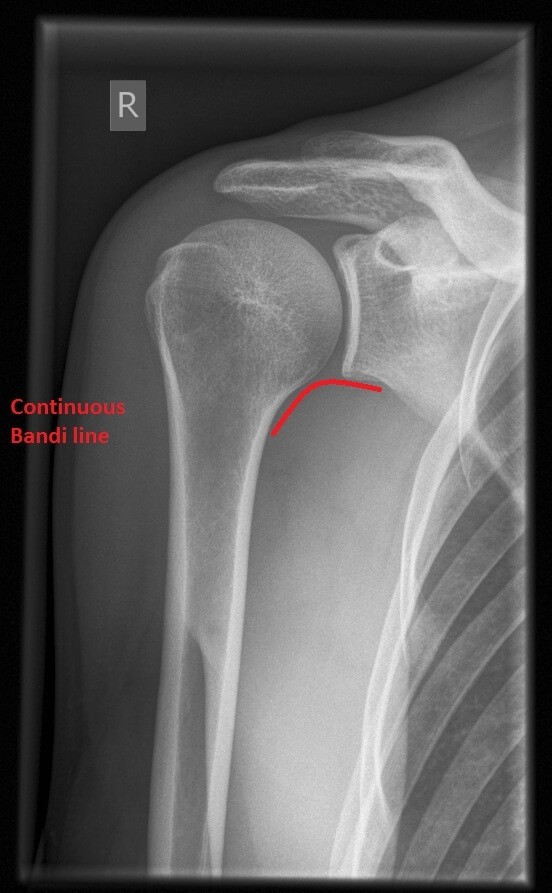 Shoulder replacement surgery costs