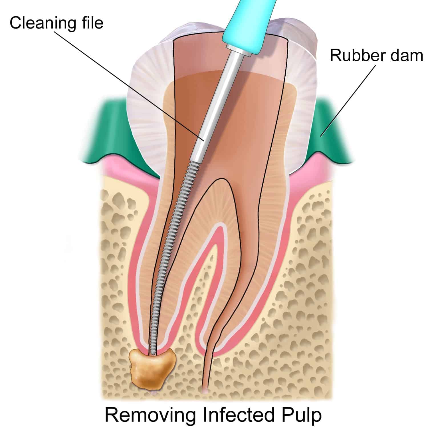 travel insurance root canal