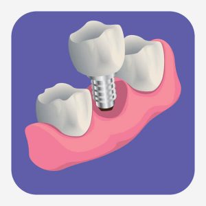 Multiple teeth implants