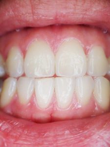 Procedure For Gum Contouring Image of tooth Gums